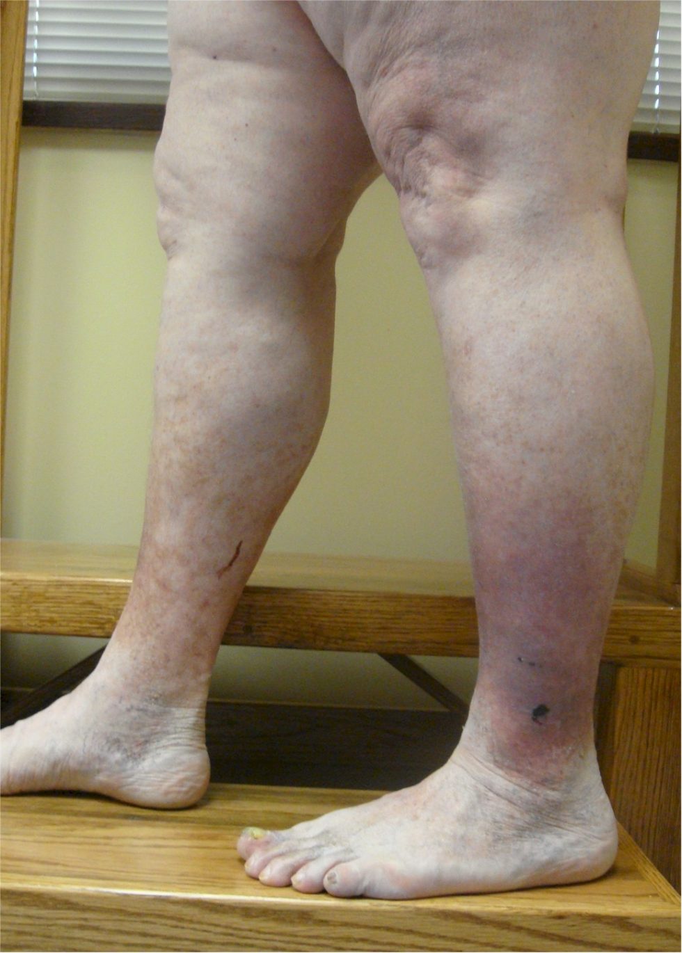 Stasis Dermatitis Varicose Veins and Skin Problems