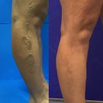 Why do I Need to Wear Compression Stockings after Treatment?