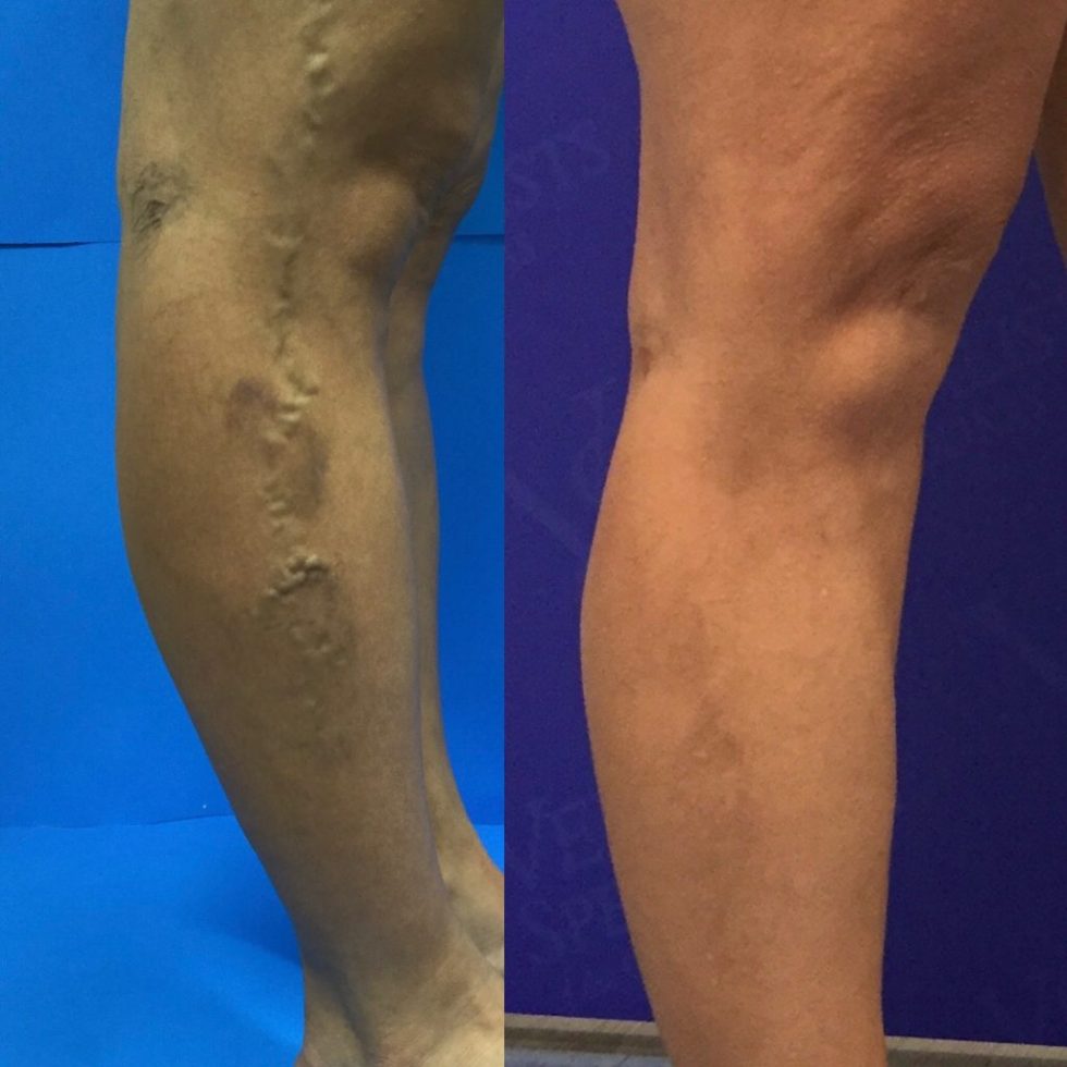 List 96+ Pictures Before And After Compression Socks For Varicose Veins