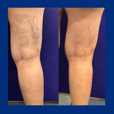 before_and_after_sclerotherapy