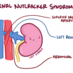What To Expect When You Visit Our Vein Care Center!, Vein Specialists of the Carolinas Nutcracker Syndrome