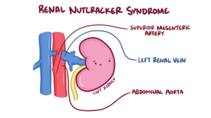 Nutcracker Syndrome