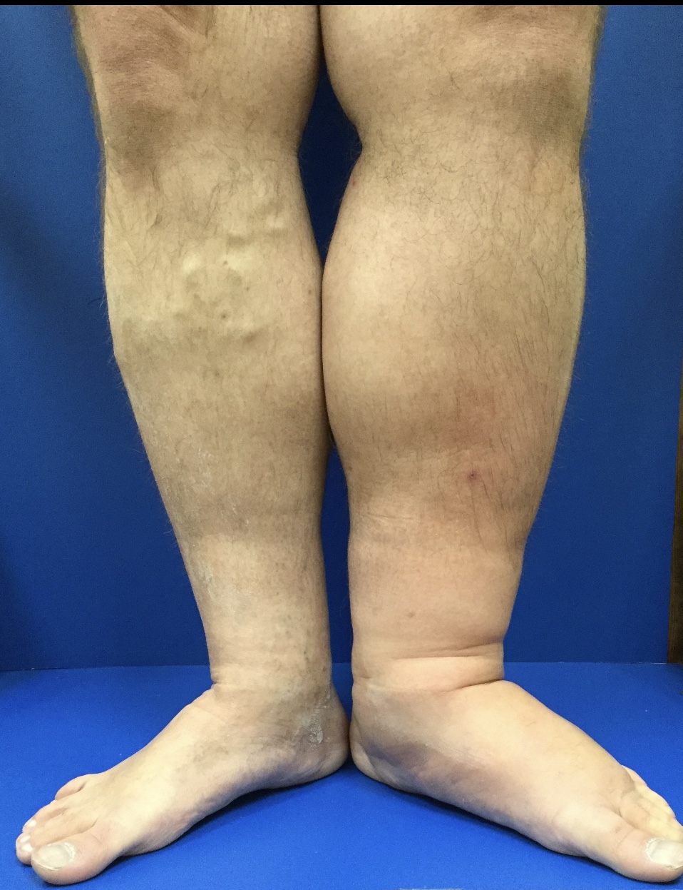 May Thurner Syndrome, Puffy Left Leg, Lymphedema Treatment