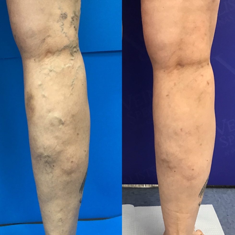 Causes of Spider Veins Vein Specialists of the Carolinas
