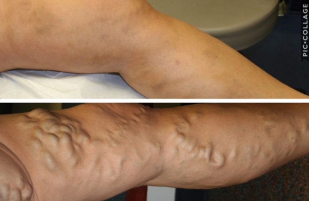 varicose-veins-charlotte-varicose-vein-treatment-gastonia