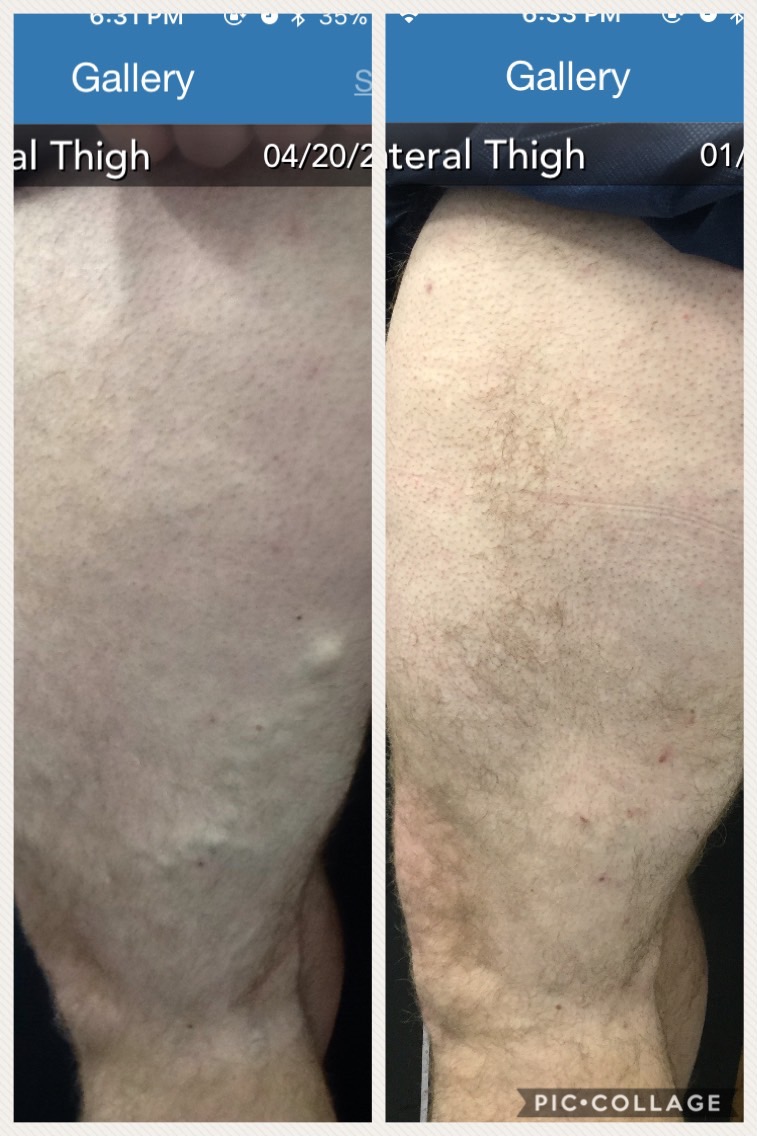 Before and After Vein Treatments
