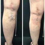 Give Yourself the Gift of Vein Treatment