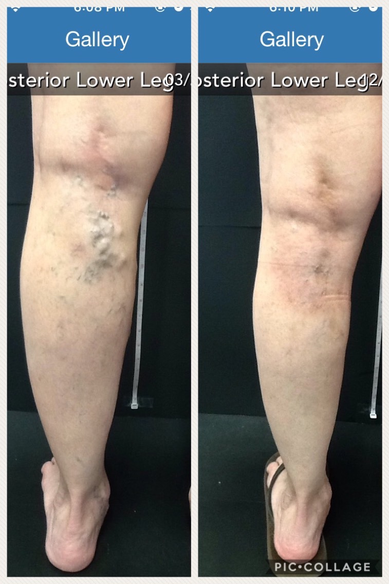 Before And After Vein Treatments Vein Specialists Of The Carolinas
