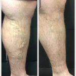 Evolution of Vein Treatments Before and After Vein Treatments