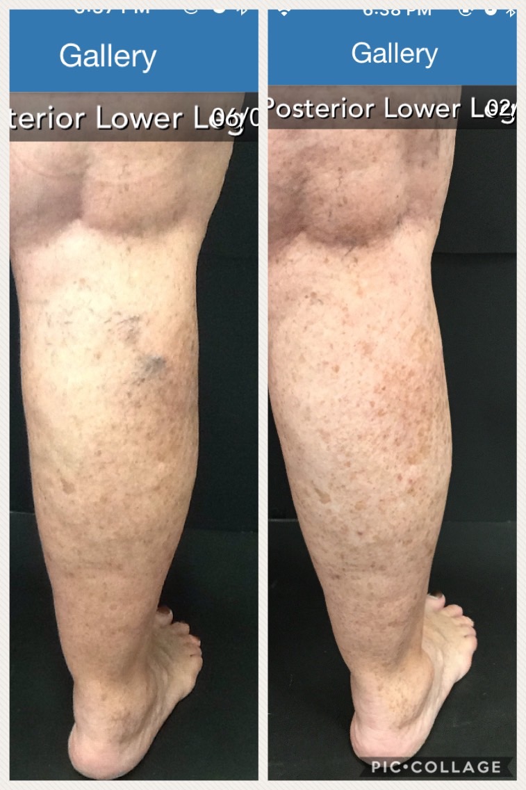 Before and After Vein Treatments