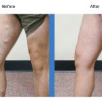 Sclerotherapy Is A Less-Invasive Way To Get Rid Of Varicose And Spider Veins
