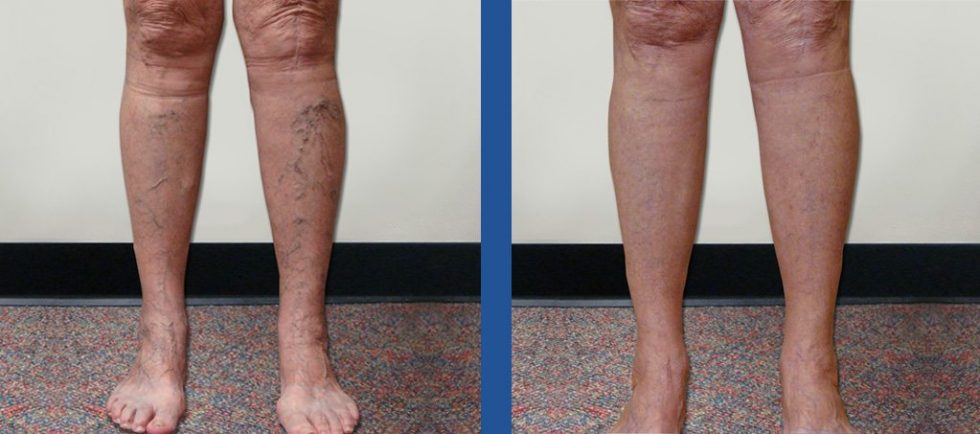 Before And After Vein Treatments Vein Specialists Of The Carolinas