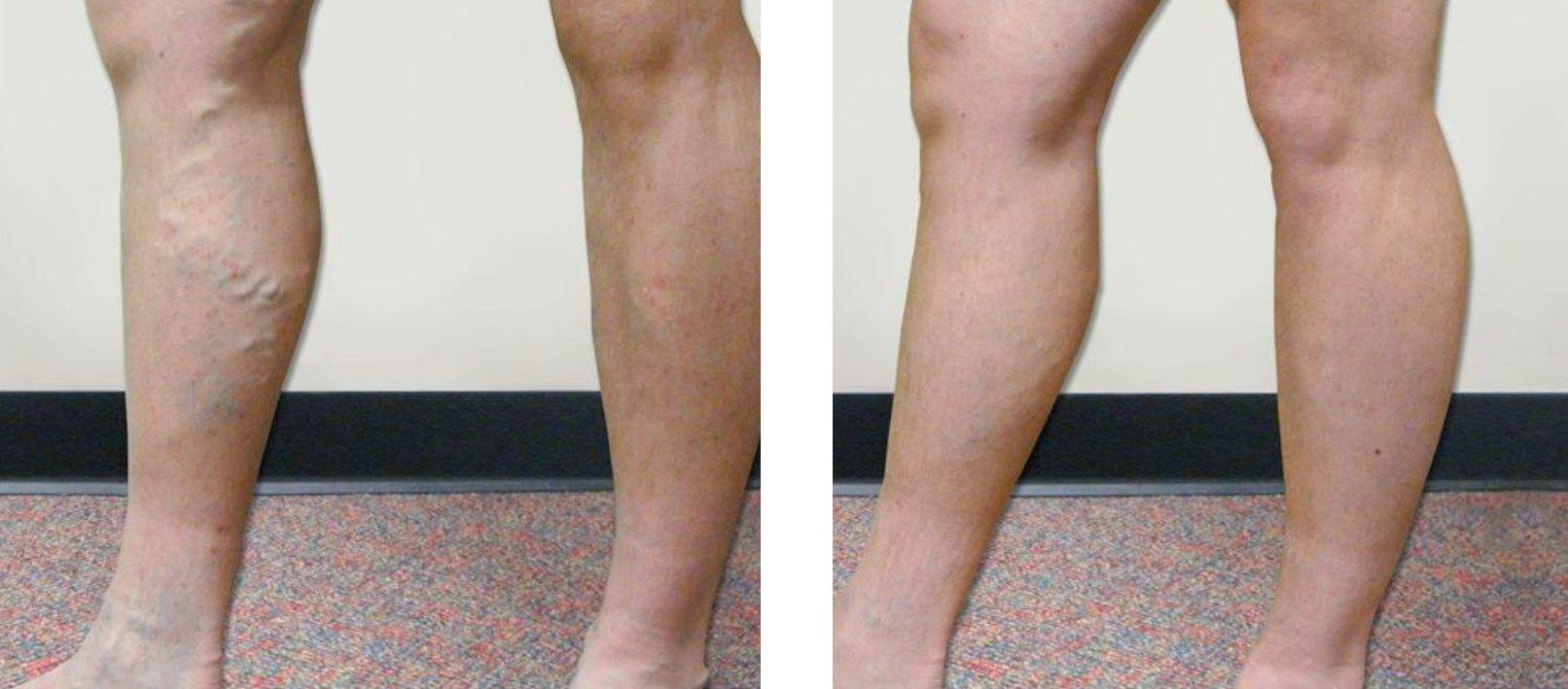 Why Vein Screening Is Important For Detection And Treatment Of Vein Disorders.