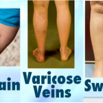 Veins, DVT_Vein_Treatment_for_both_supervicial_veins_and_the_deep_venus_system_are_important