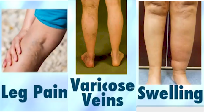 UGFS Varicose Vein Treatment