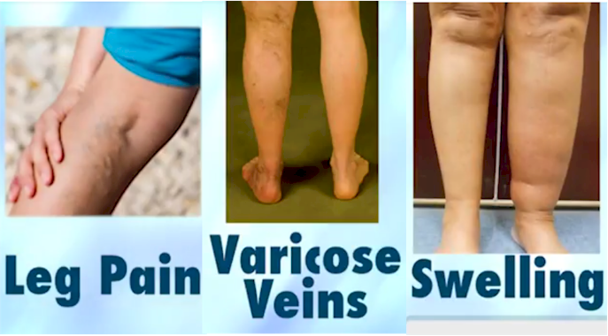 The Connection Between Vein Damage and Leg Swelling