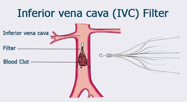 Inferior Vena Cava Filter IVC Filter Vein Specialists Of The Carolinas