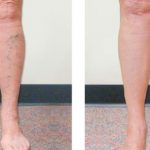Valentines Special On Cosmetic Sclerotherapy - Vein Specialists Of The Carolinas