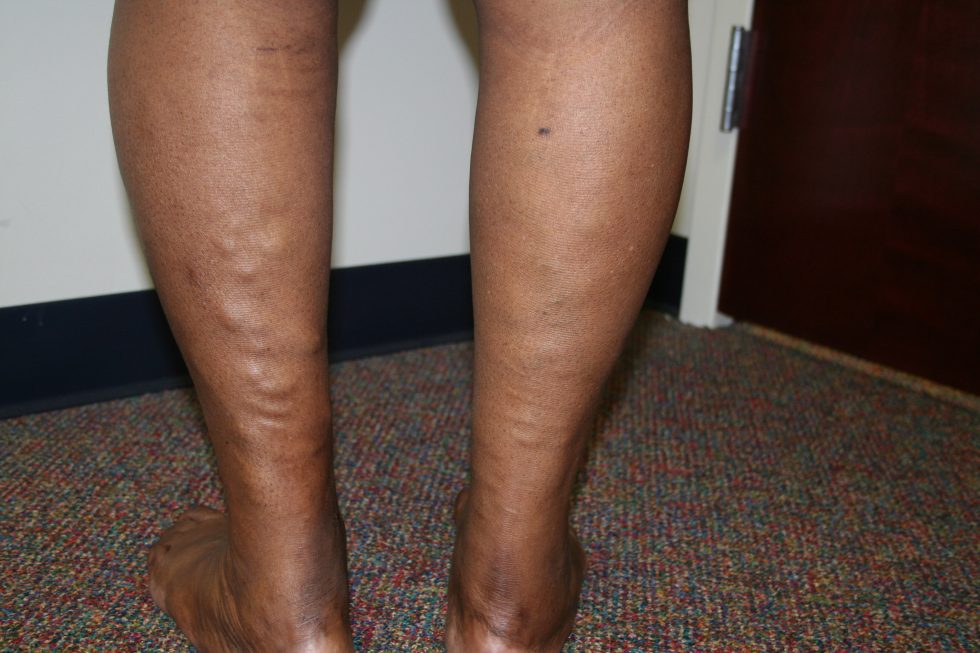 How to Deal with Leg Cramps Vein Specialists of the Carolinas