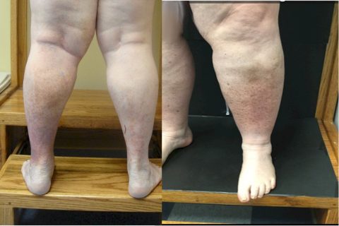 Chronic Venous Insufficiency Vein Disorders. Vein Specialists of Carolinas