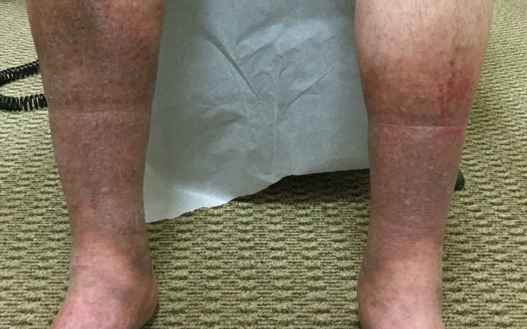 Why Do I Have Brown Spots on My Legs?