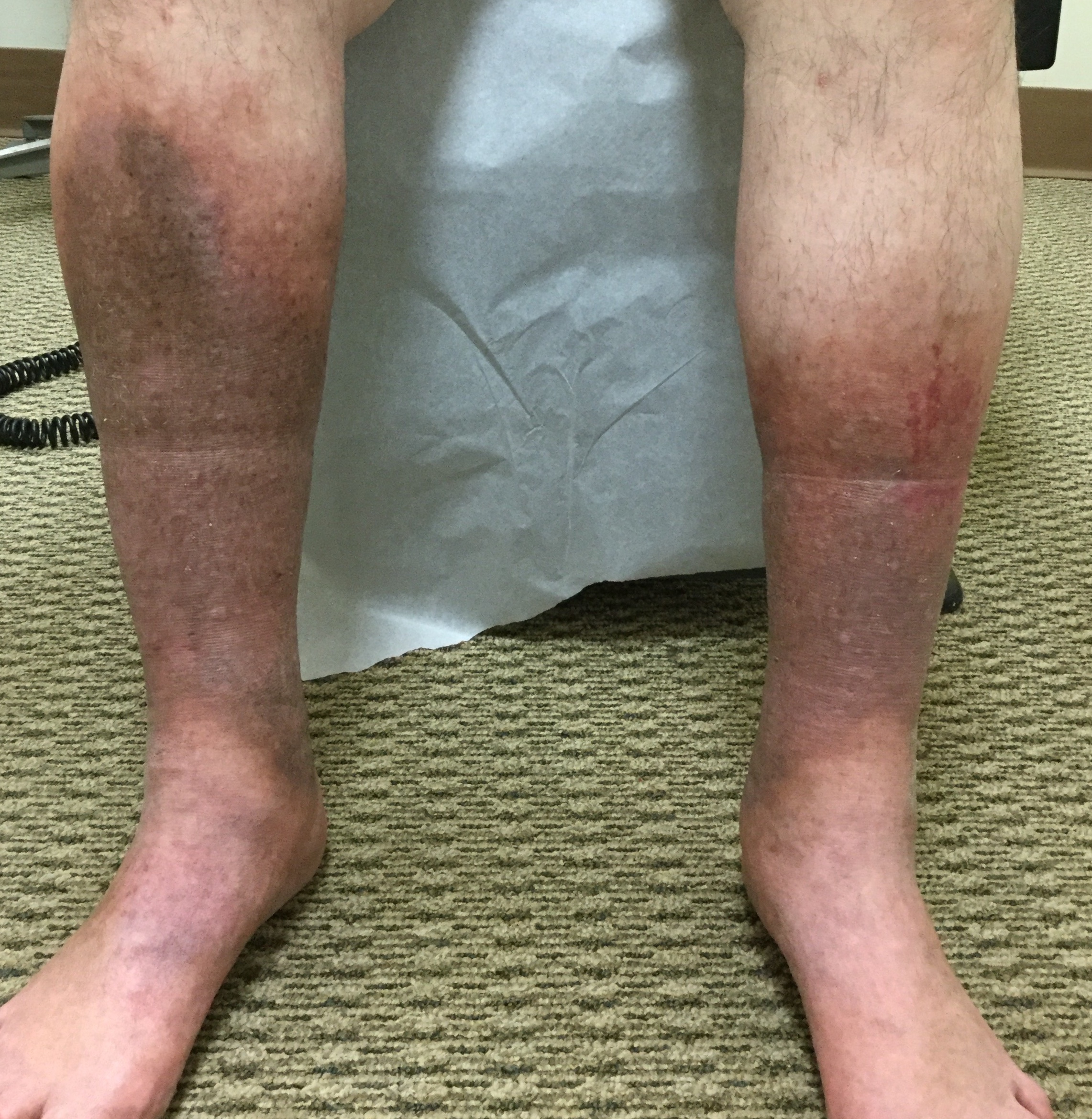 Why Do I Have Brown Spots on My Legs?