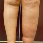 Edema MayThurner Swelling