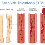 Are You at Risk for DVT?