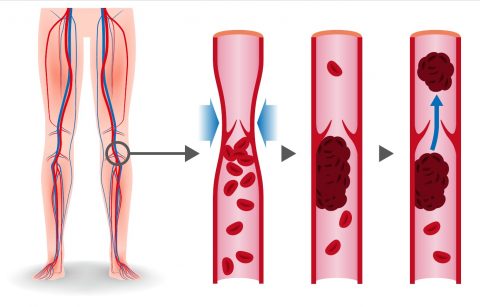 Deep Vein Thrombosis (DVT) - Vein Specialist of the Carolinas