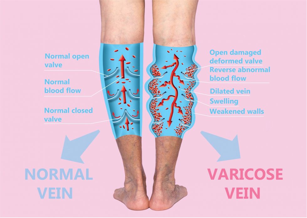 Vein Treatments Vein Specialists Of The Carolinas Treat Thousands Yearly