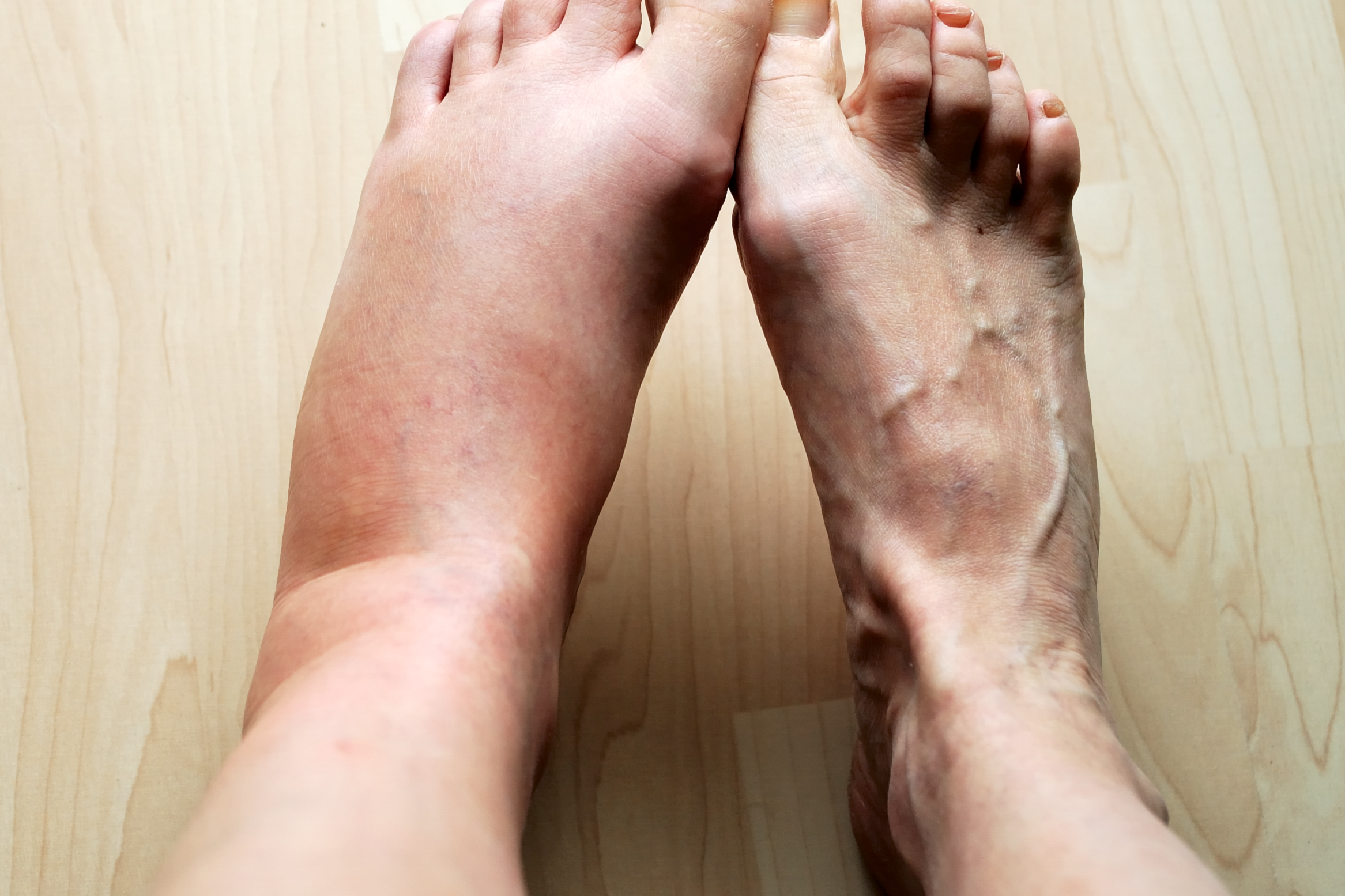 Leg Swelling Or Medical Term Edema Vein Specialists Of The Carolinas