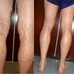 Today is Transformation Tuesday! Check out this amazing before and after photo., Vein Specialists of the Carolinas 5 Tips for Relieving Painful Varicose Veins