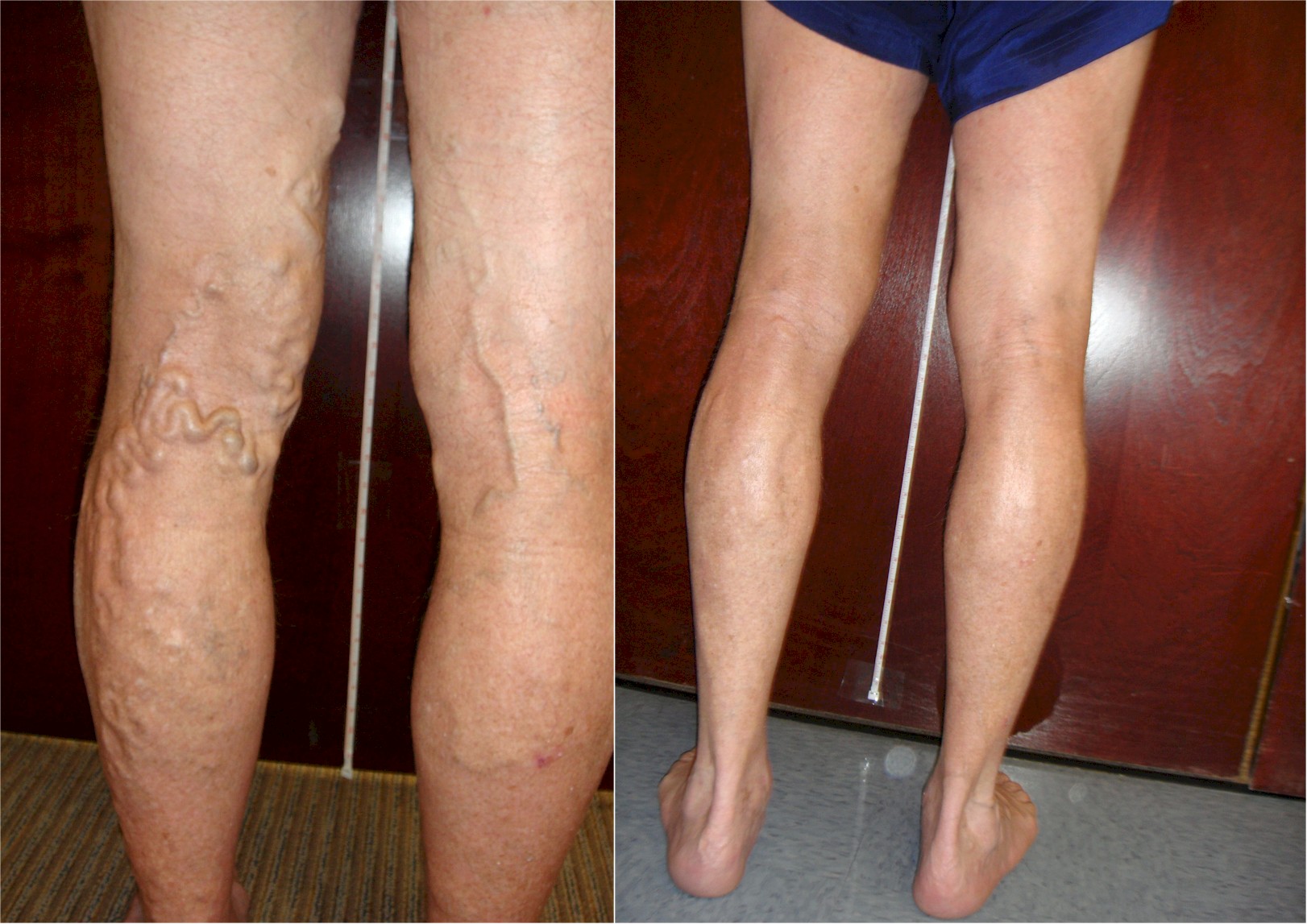 Relieving Painful Varicose Veins - Vein Specialists of Carolinas