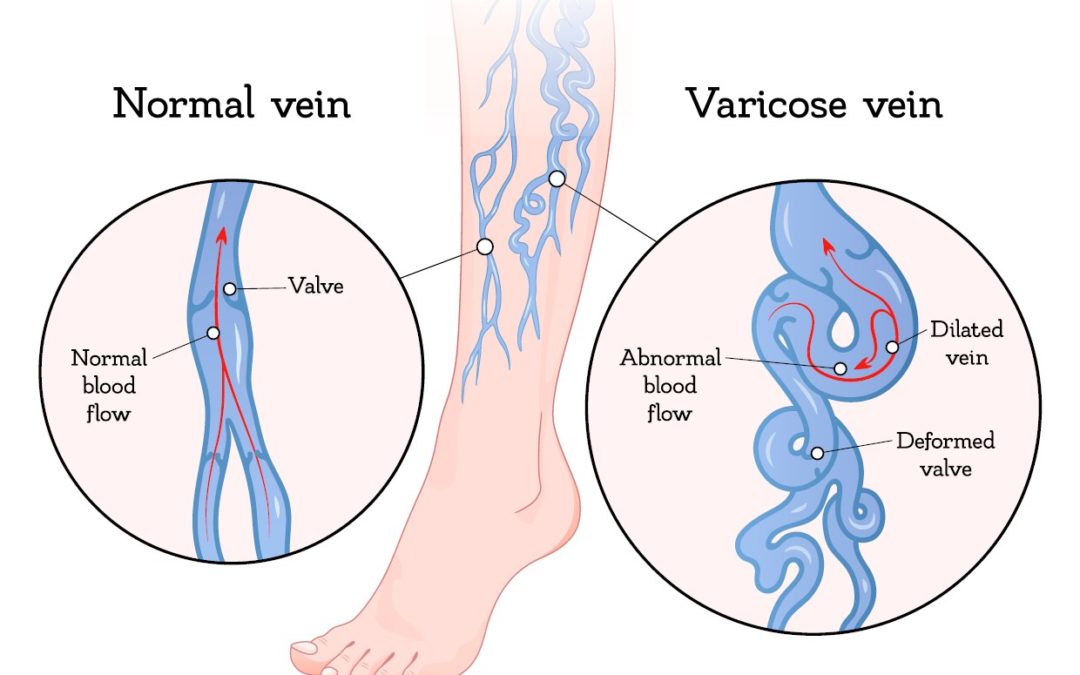 Spend some time this fall saying goodbye to your uncomfortable, unattractive varicose veins for good!