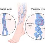 The Effects and Benefits of Medical Compression, Vein Specialists of the Carolinas Spend some time this fall saying goodbye to your uncomfortable, unattractive varicose veins for good...