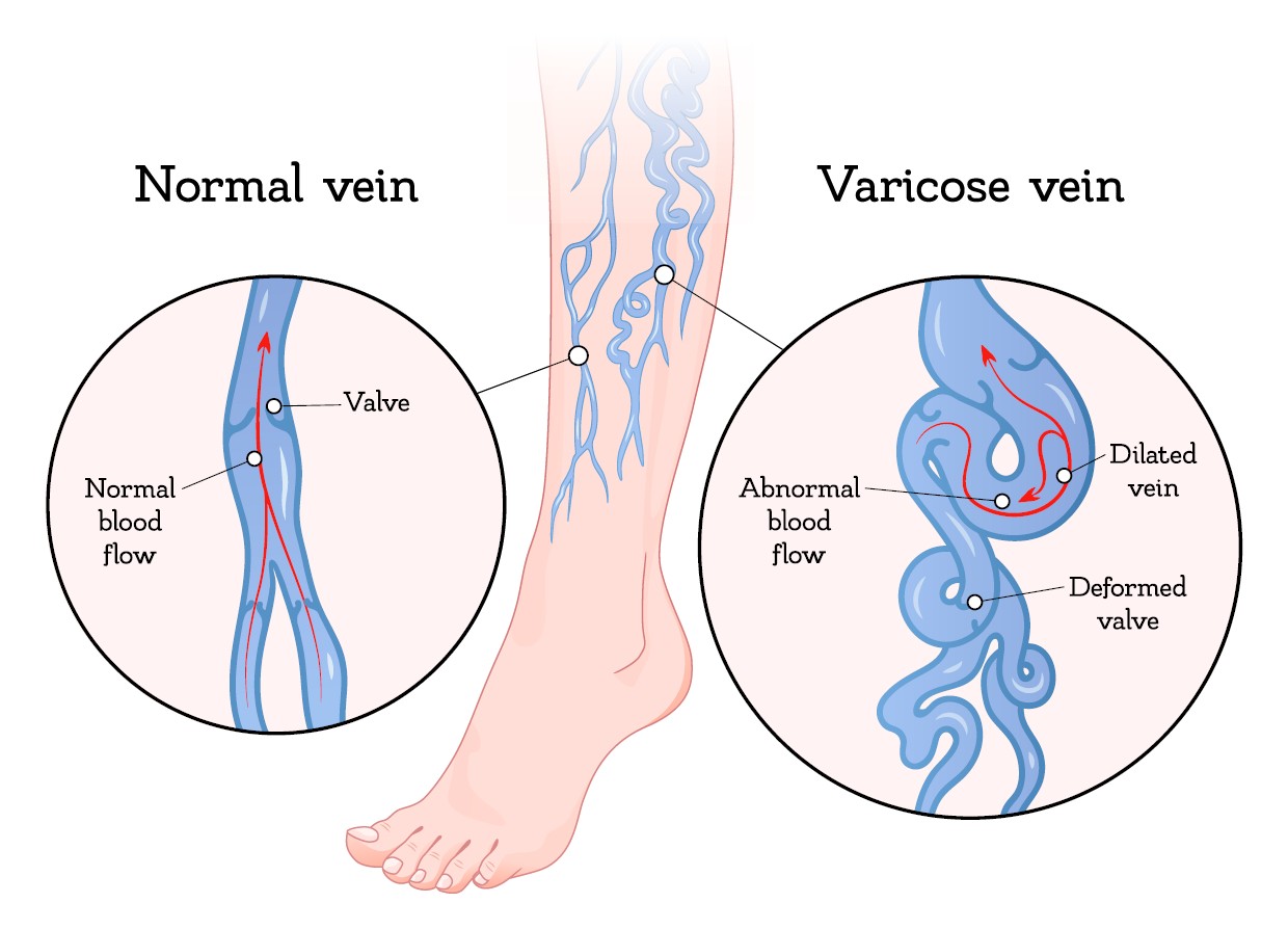 Chronic Venous Insufficiency - Vein Specialists of the Carolinas