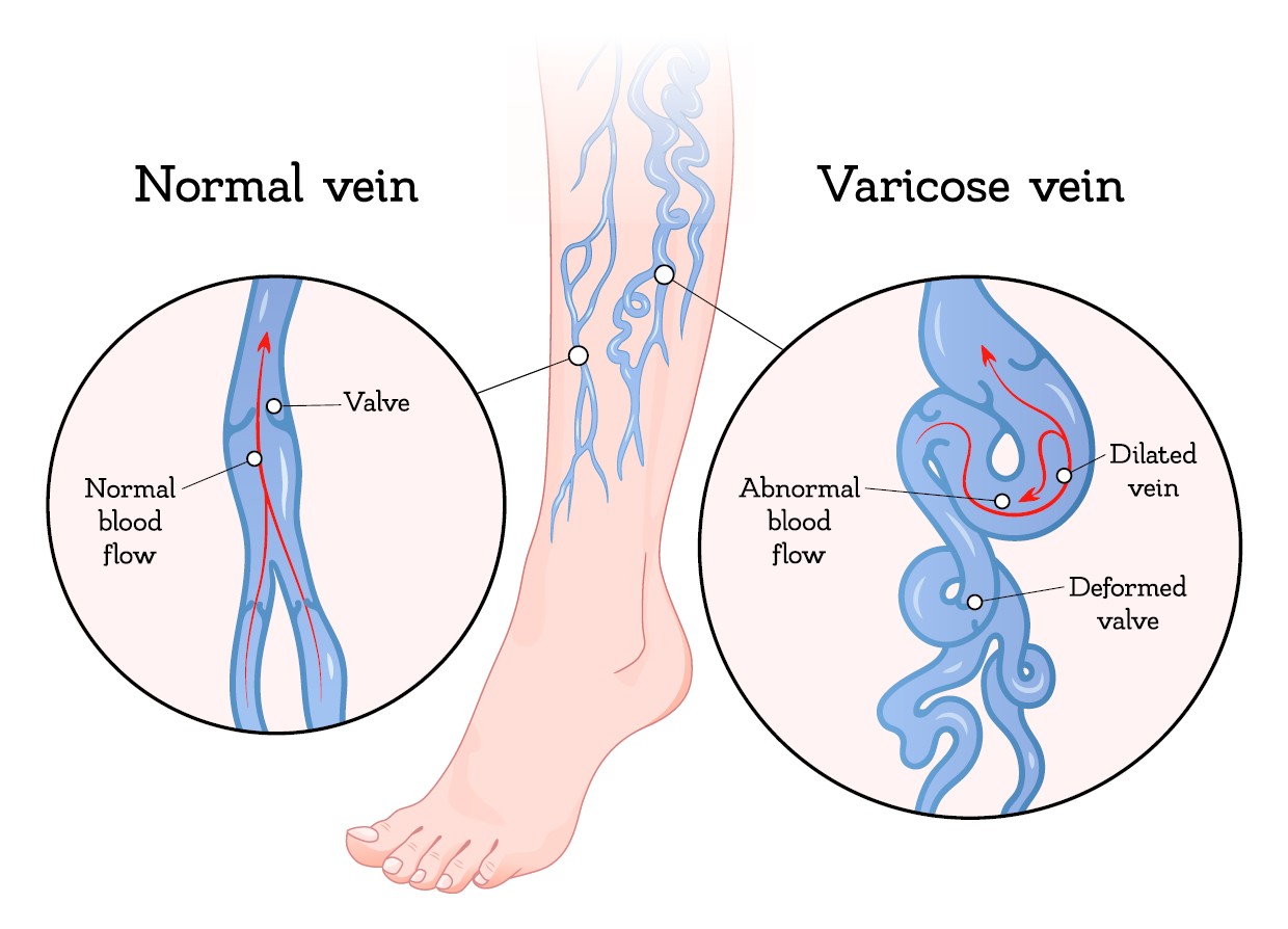 The Beneficial Effects Of Wearing SIGVARIS Compression Stockings. - Vein  Specialists of the Carolinas