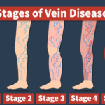 Spider Veins or Varicose Veins: What is the Difference?, Vein Specialists of the Carolinas Vein Health: Lifestyle or Genetics?
