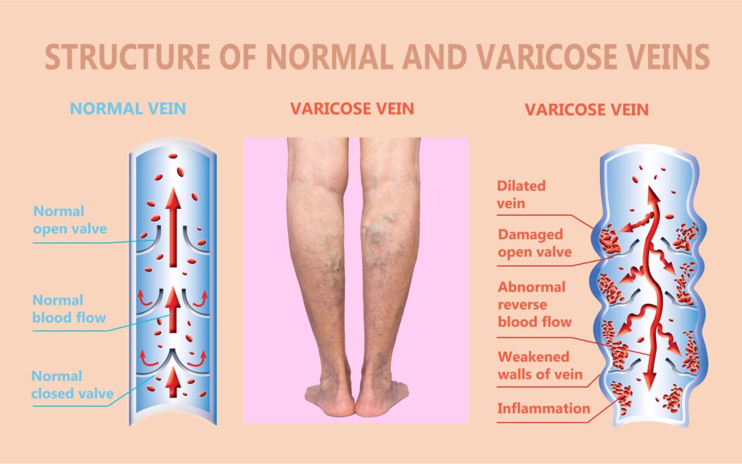 What Causes Vein Disorders? - Vein Specialists of the Carolinas