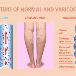 What Are The Basics of Venous Disease?, Vein Specialists of the Carolinas What Causes Vein Disorders?