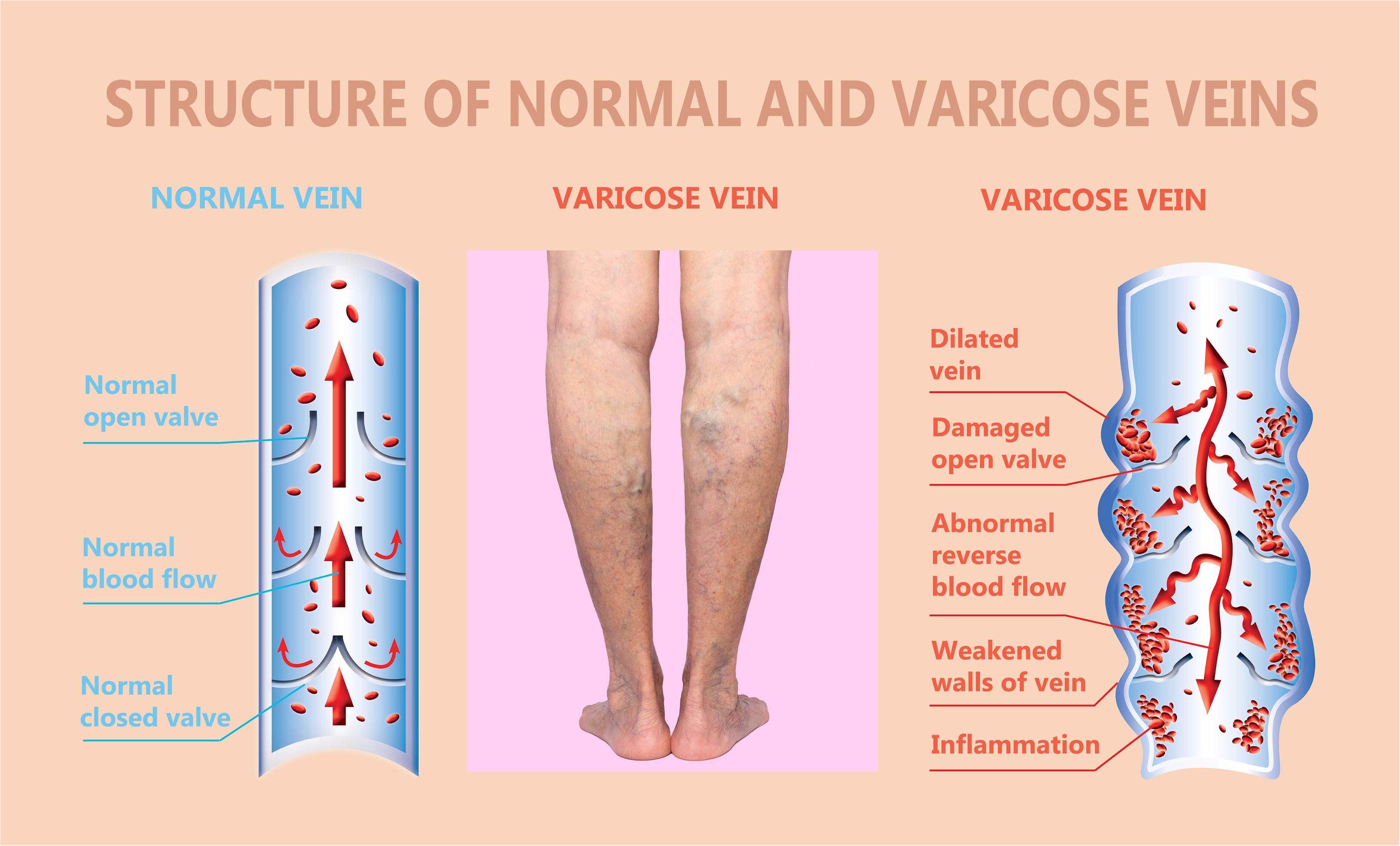 Vein Disorders - Vein Specialists of the Carolinas - All We Do Is