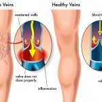 How Nutrition Affects Your Vein Health