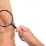 Is There an Easy Fix for My Vein Disorder?
