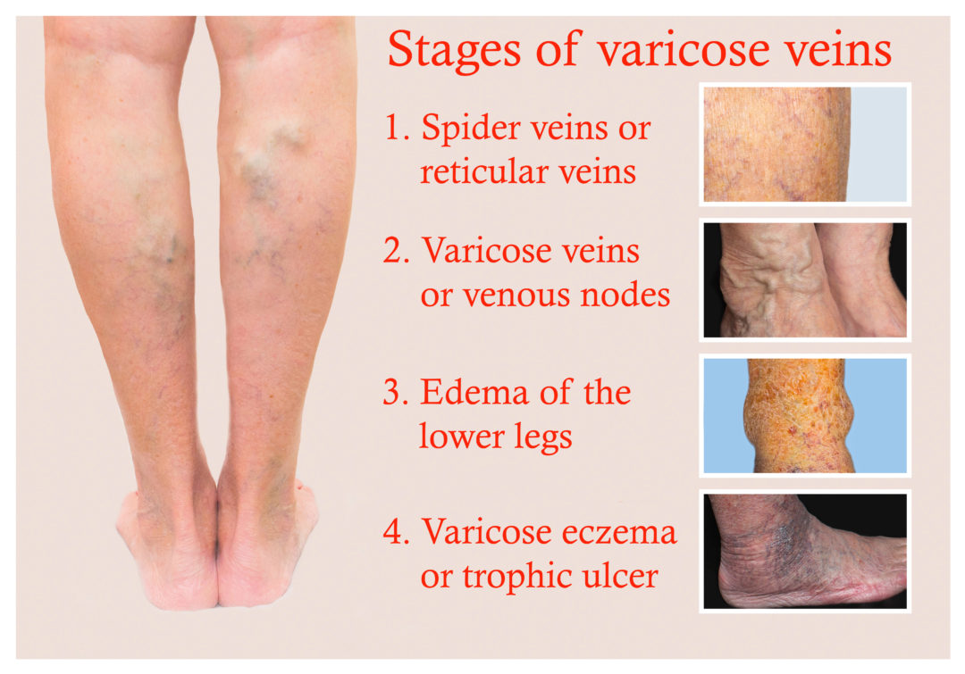 Vein Disorders - Vein Specialists of the Carolinas - 