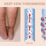 Decreased Activity Can Increase The Risk Of Blood Clots, Vein Specialists of the Carolinas Deep Vein Thrombosis