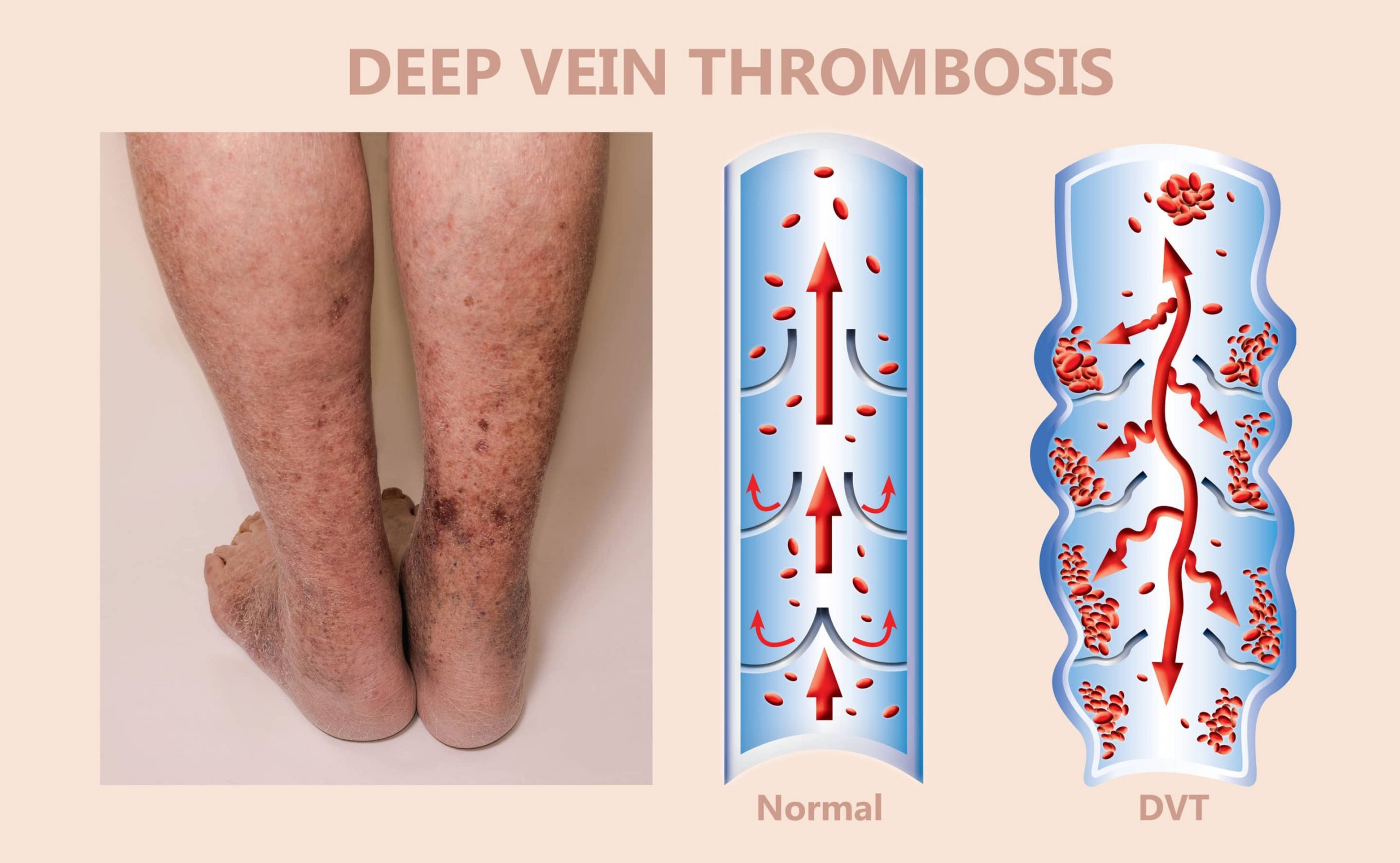 deep vein thrombosis definition