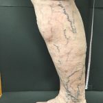 Got Spider Veins?