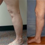 How Can You Help Alleviate Pain From Varicose Veins?, Vein Specialists of the Carolinas Varicose Vein Treatment - Before and After. The results are awesome!