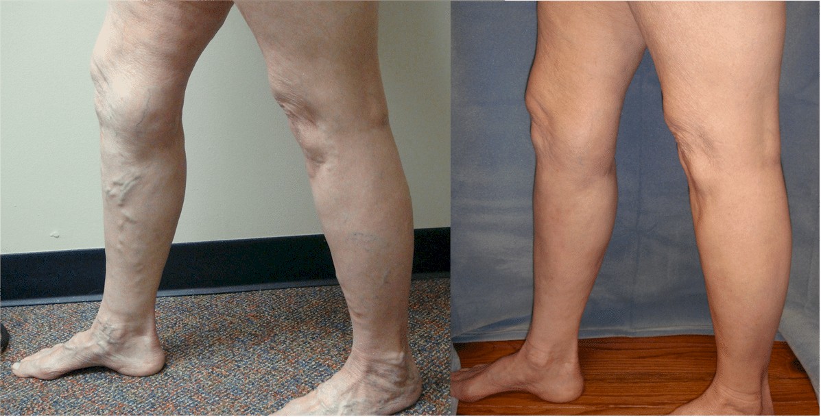 Varicose Vein Treatment - Before and After. The results are awesome! - Vein  Specialists of the Carolinas