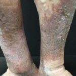 Chronic Venous Insufficiency - Know The Symptoms